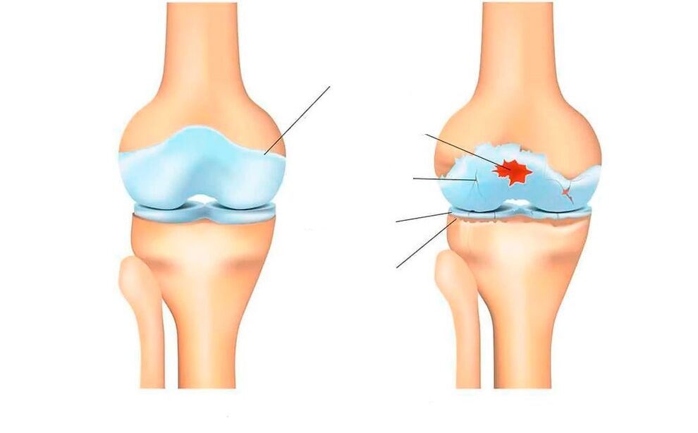 articulación sa e con artrose
