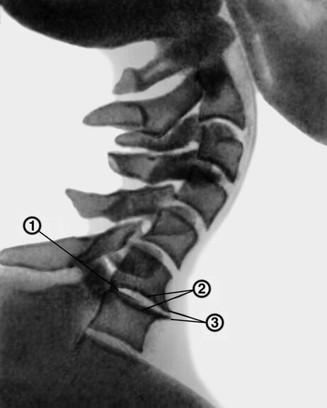 Radiografía da columna cervical con osteocondrose