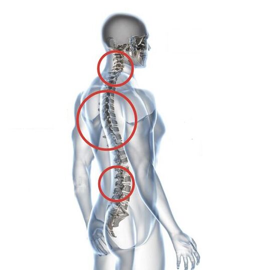 Como se manifesta a osteocondrose