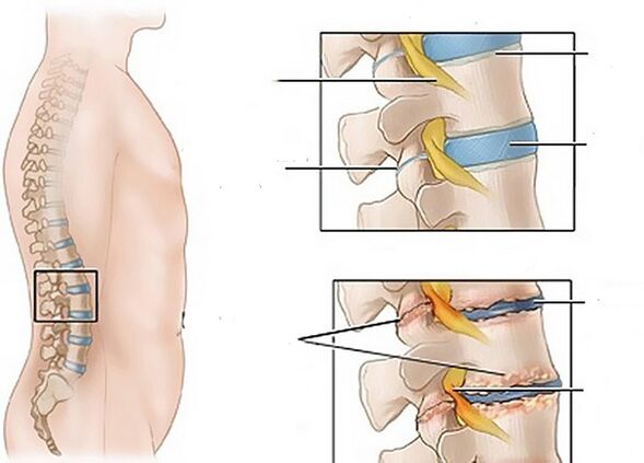 cambios nos discos debido á osteocondrose