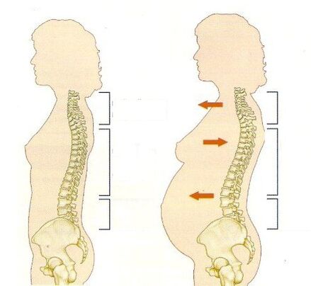 osteocondrose durante o embarazo