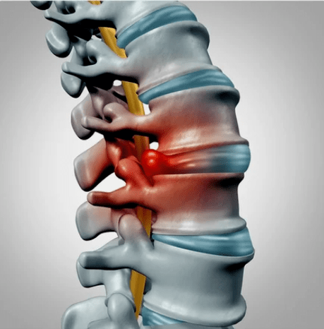 Protencia dos discos intervertebrais